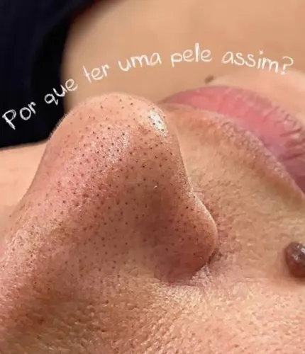 Limpeza de pele