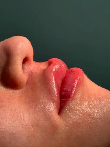 Preenchimento Labial