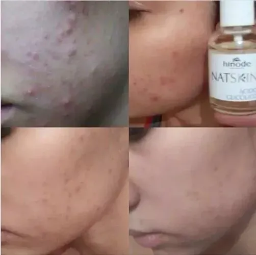 ácido glicólico revendo manchas