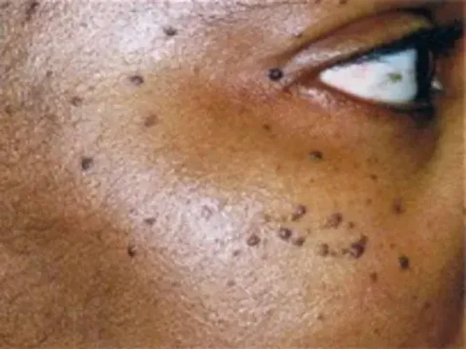  Remoção de Sinais de pele com Jato de Plasma - Resultado Rápido e Seguro!