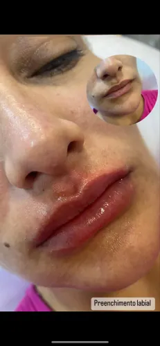 Preenchimento labial