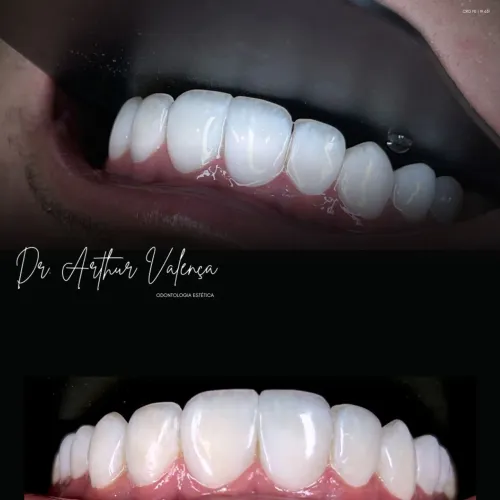 Facetas em Resina Premium