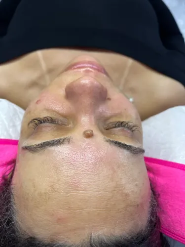Limpeza de pele profunda completa 