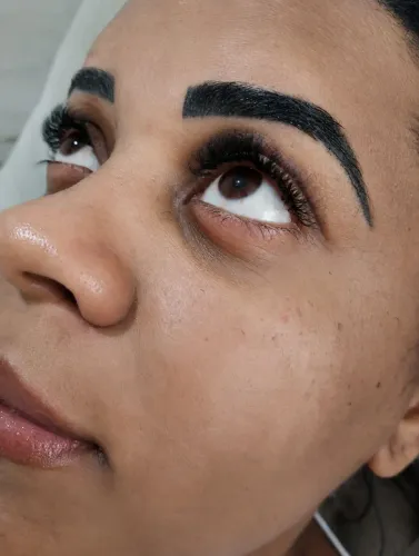 PROCEDIMENTOS ESTETICOS