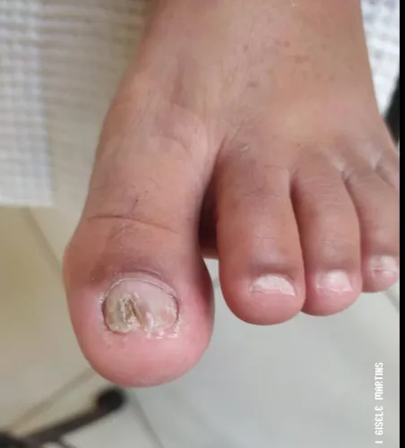 Micose