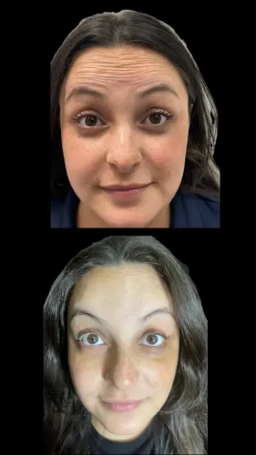 Botox Full Face