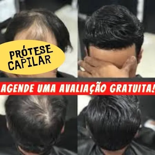 protese capilar para homem