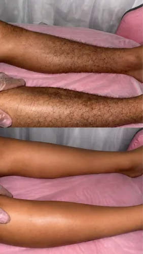DEPILAÇÃO