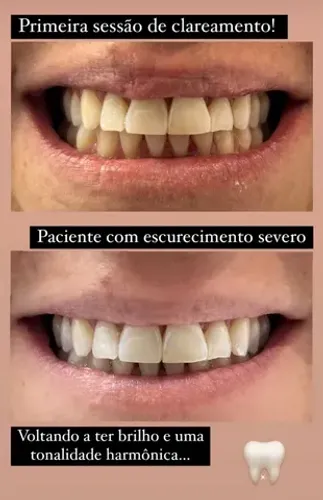Clareamento dental laser