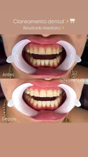 Clareamento dental 