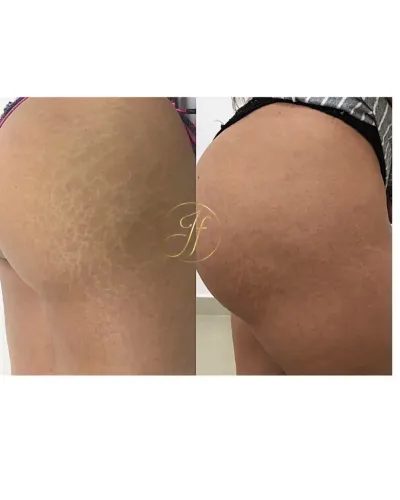 Tratamento de estrias com colágeno 