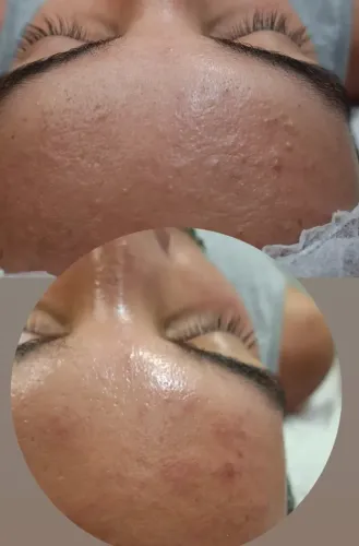 Limpeza de pele profunda com resultado imediato.