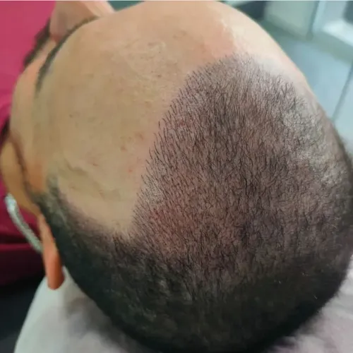 Micropigmentação capilar 