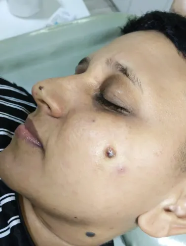 Remoção sinal, verruga, quelóide, fibroma mole, cisto sebáceo com jato de plasma