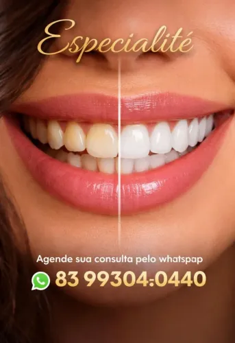 Facetas em Resina em João Pessoa - Sorriso Perfeito e Natural
