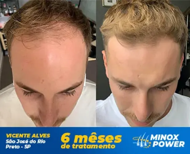 Produto pra queda de cabelo / crescimento capilar
