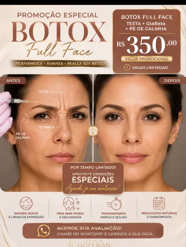 Paciente modelo para botox 