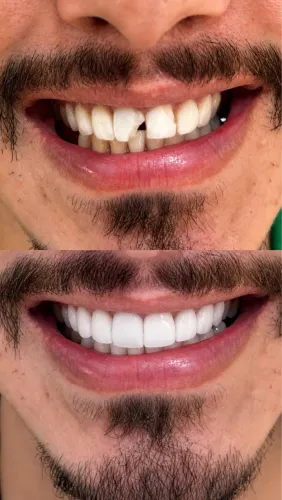Dentista | Facetas em resina | Clareamento | Implantes dentários 