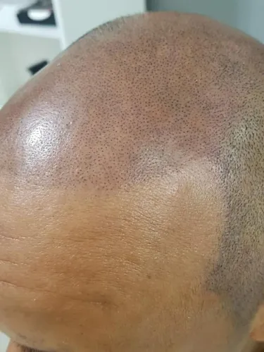 Micropigmentação capilar ao seu alcance