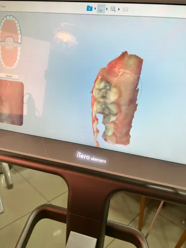 Scanner Intraoral Odontológico - ITero Element 2