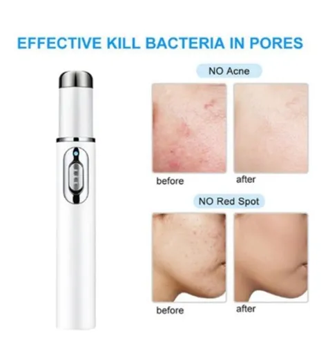 Luz azul para tratamento de acne e microvarizes
