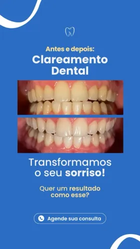 Clareamento Dental + profilaxia grátis 