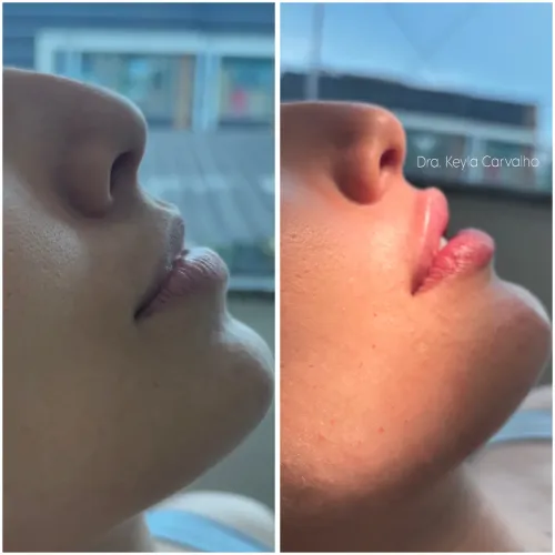 Preenchimento labial 