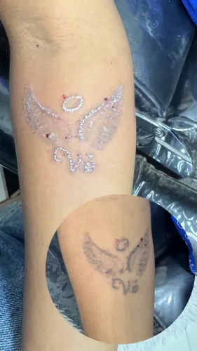 Remoção de tatuagem e micropigmentação a laser