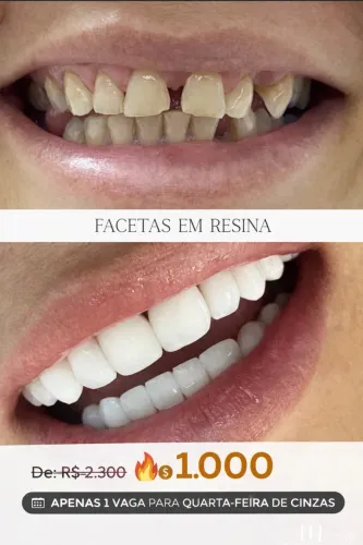Facetas em resina na promoção