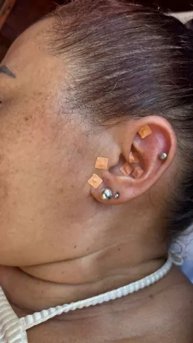 Auriculoterapia