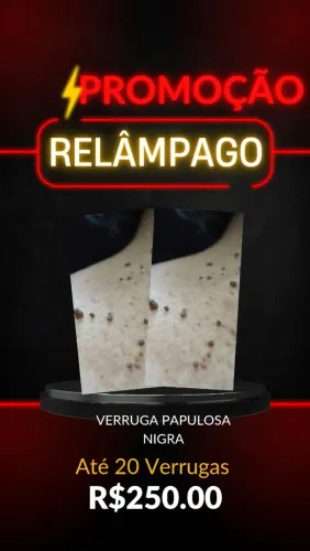 Remoção de verruga