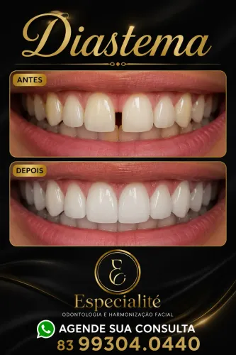 DIASTEMA  Feche o espaço. Valorize o seu sorriso.