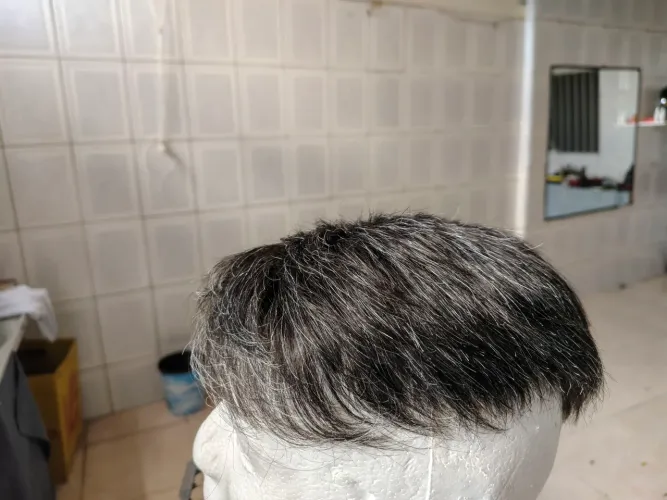 Prótese capilar