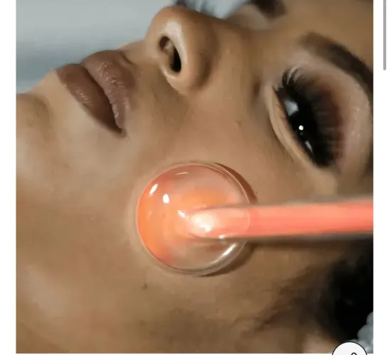 Eletrodos alta frequência cebolão e cauterização 