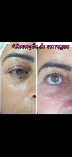 Remoção de verrugas com jato de plasma